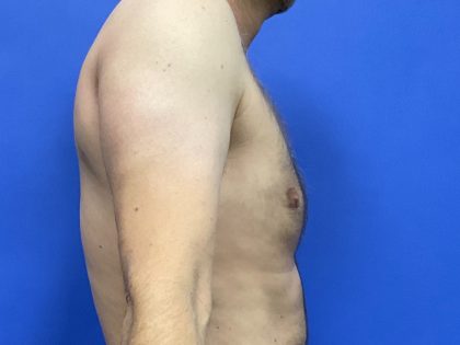 Standard Liposuction Before & After Patient #10468