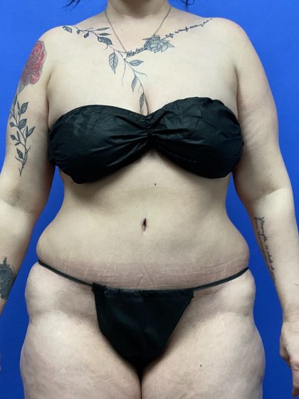 Tummy Tuck - Extended Before & After Patient #10464