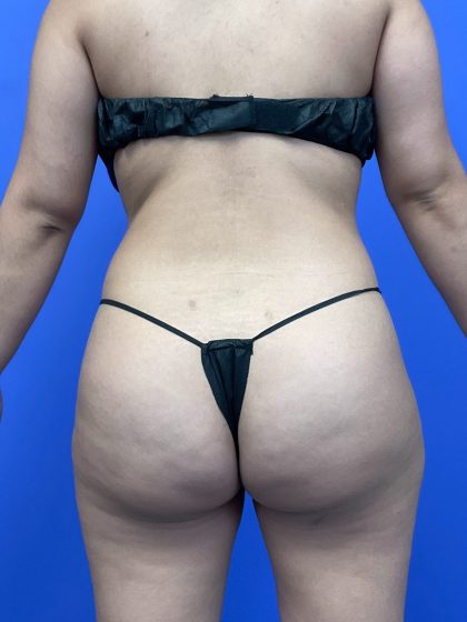 Brazilian Butt Lift Before & After Patient #10497