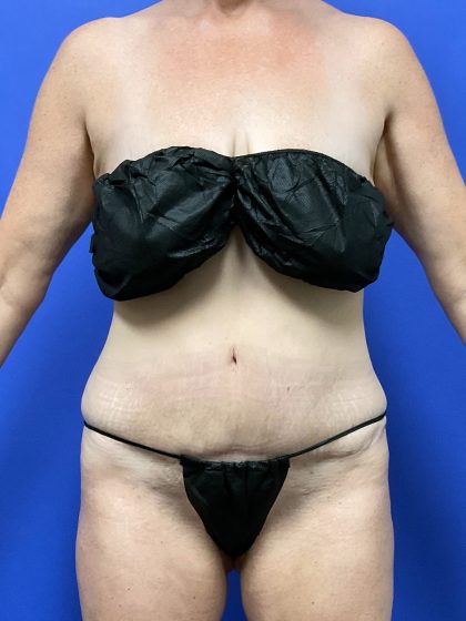 Tummy Tuck - Extended Before & After Patient #10499