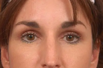 Upper Blepharoplasty Before & After Patient #10463