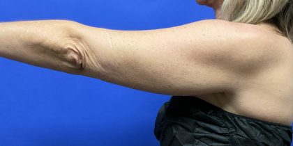 VASER Hi-Def Arm Liposuction Before & After Patient #10504