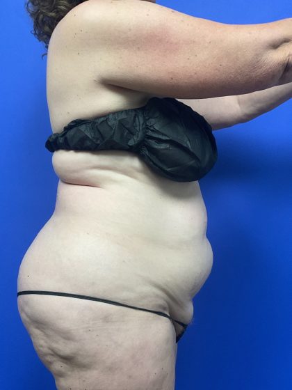 Tummy Tuck - Extended Before & After Patient #10576