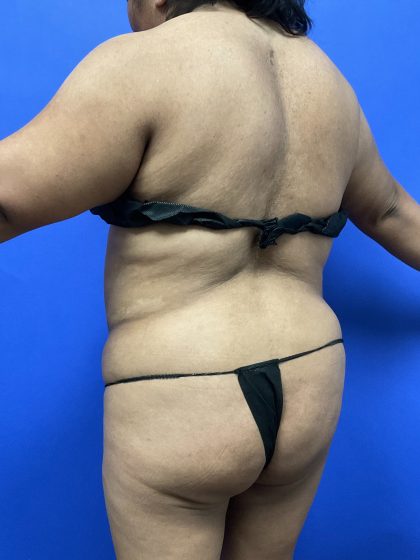 Back Liposuction Before & After Patient #10554