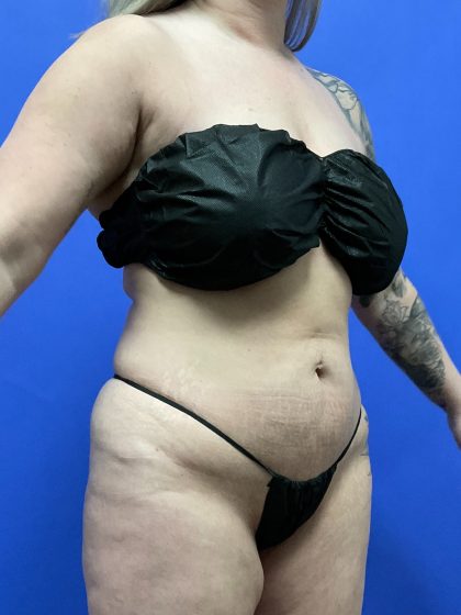 VASER Hi Def Liposuction Before & After Patient #10555