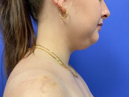 Chin Liposuction Before & After Patient #10557