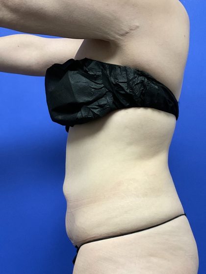 Tummy Tuck Before & After Patient #10467