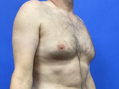 Standard Liposuction Before & After Patient #10468