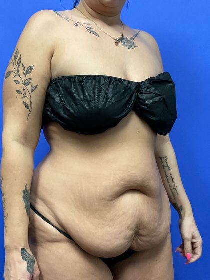 Tummy Tuck - Extended Before & After Patient #10464
