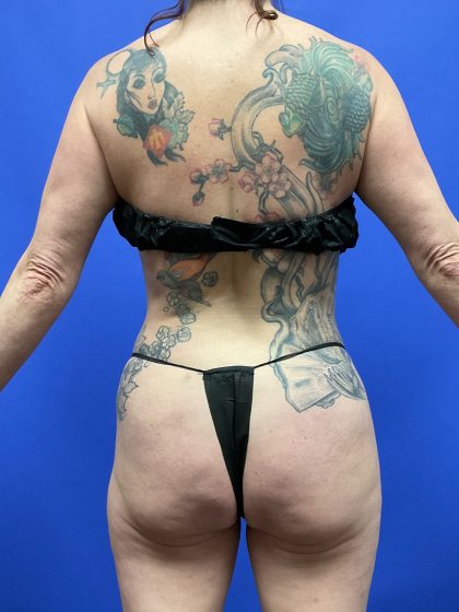 Brazilian Butt Lift Before & After Patient #10465