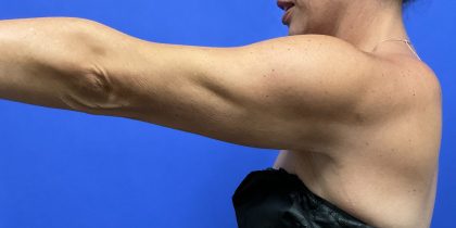 VASER Hi Def Liposuction Before & After Patient #10502