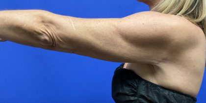 VASER Hi-Def Arm Liposuction Before & After Patient #10504