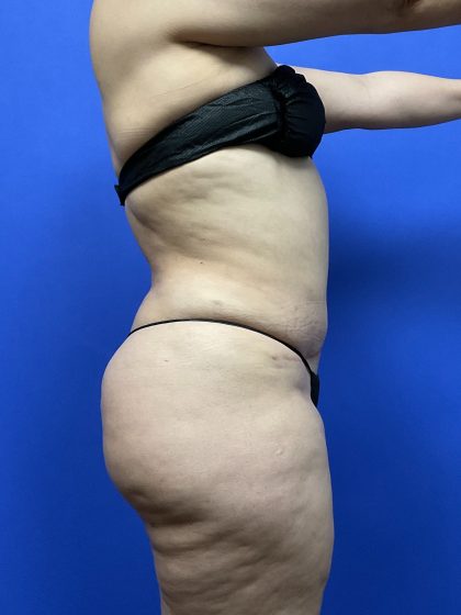 Brazilian Butt Lift Before & After Patient #10574