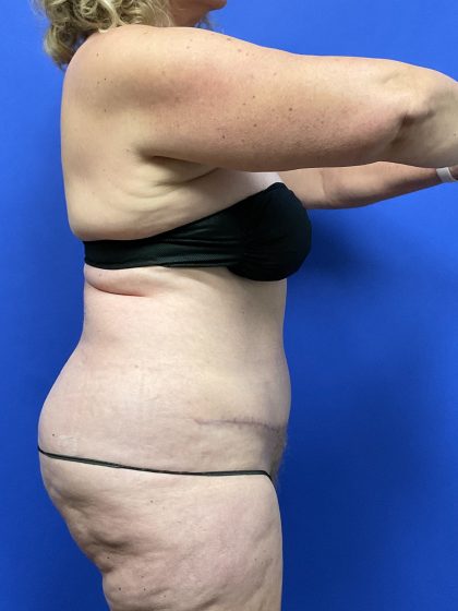 Tummy Tuck - Extended Before & After Patient #10576