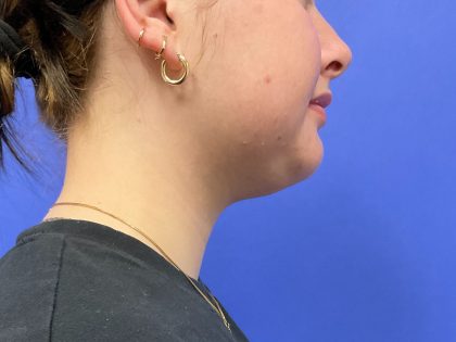 Chin Liposuction Before & After Patient #10557
