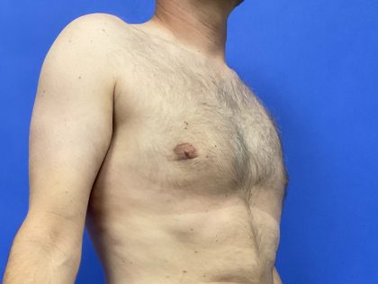 Standard Liposuction Before & After Patient #10468