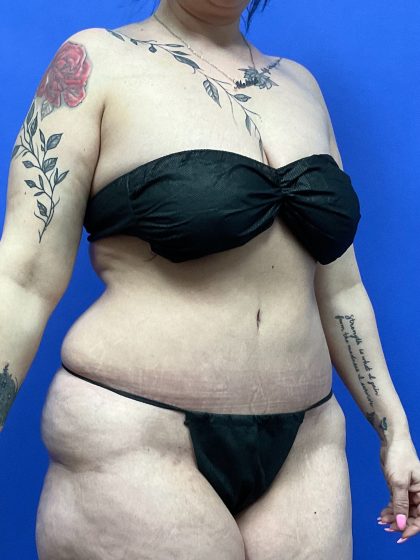 Tummy Tuck - Extended Before & After Patient #10464