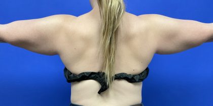 Arm Lift Before & After Patient #10466