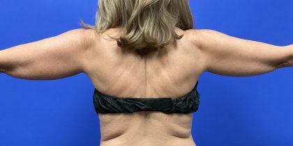 VASER Hi-Def Arm Liposuction Before & After Patient #10504