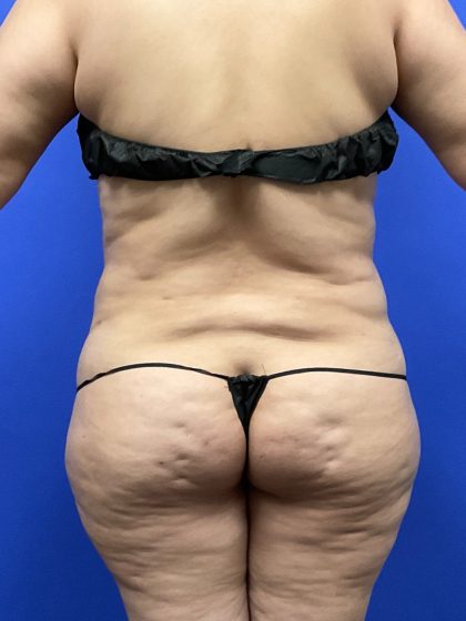 Brazilian Butt Lift Before & After Patient #10574