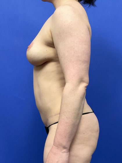 Mommy Makeover Before & After Patient #10498