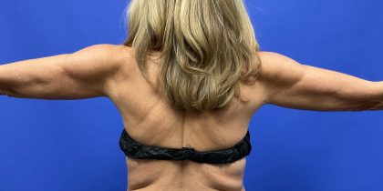 VASER Hi-Def Arm Liposuction Before & After Patient #10504