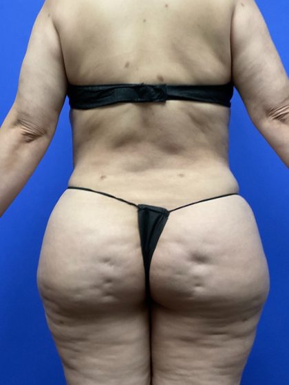 Brazilian Butt Lift Before & After Patient #10574