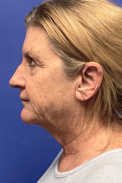Neck Liposuction Before & After Patient #10648