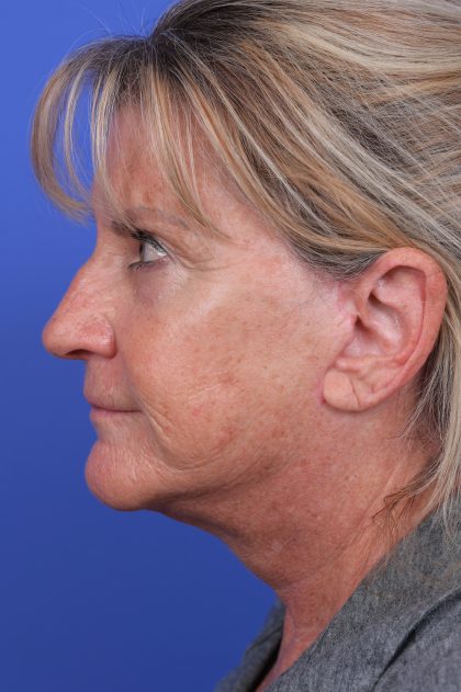Neck Liposuction Before & After Patient #10648