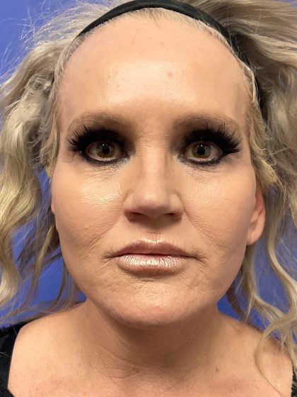 Lower Deep Plane Facelift Before & After Patient #10637