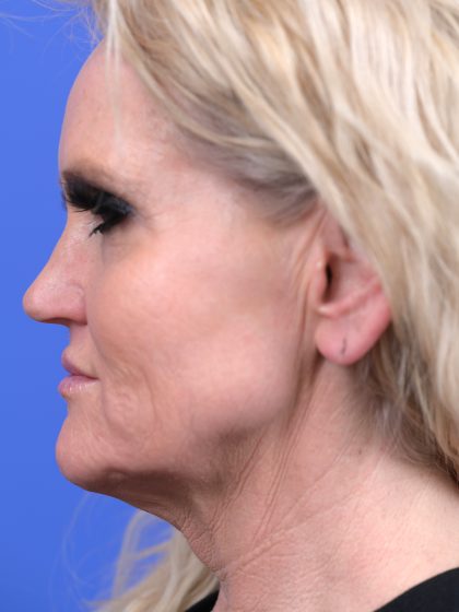 Lower Deep Plane Facelift Before & After Patient #10637