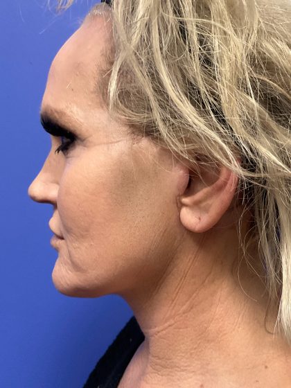 Lower Deep Plane Facelift Before & After Patient #10637