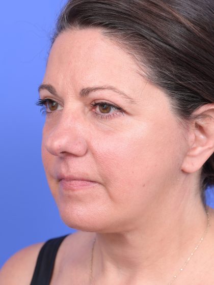 Facelift Before & After Patient #10644