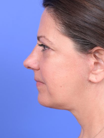 Facelift Before & After Patient #10644