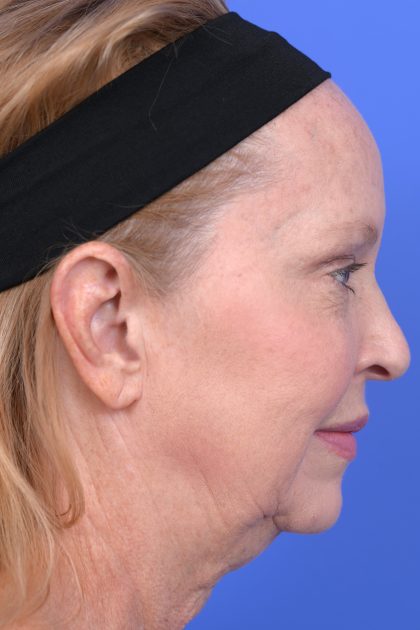 Lower Deep Plane Facelift Before & After Patient #10642