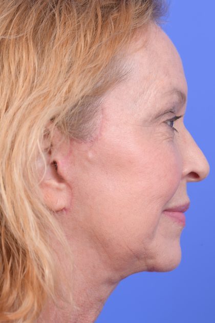 Lower Deep Plane Facelift Before & After Patient #10642