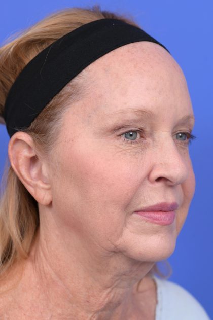 Lower Deep Plane Facelift Before & After Patient #10642