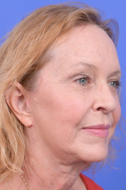 Lower Deep Plane Facelift Before & After Patient #10642