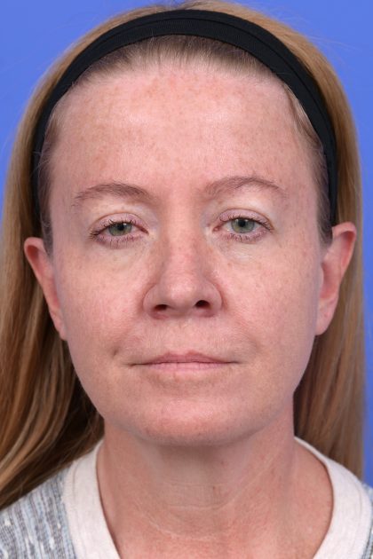 Lower Deep Plane Facelift Before & After Patient #10647