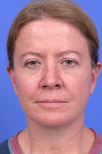 Lower Deep Plane Facelift Before & After Patient #10647