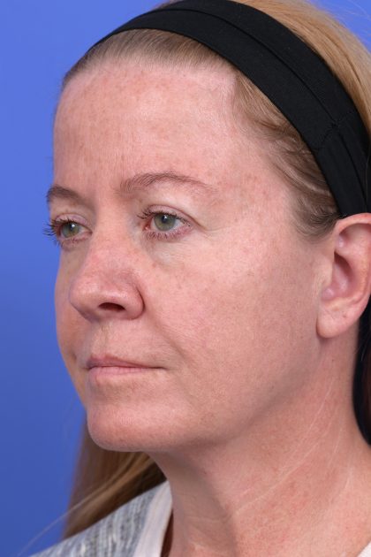 Lower Deep Plane Facelift Before & After Patient #10647