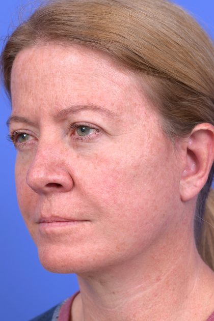 Lower Deep Plane Facelift Before & After Patient #10647