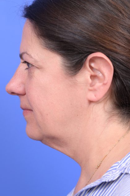 Upper Blepharoplasty Before & After Patient #10644