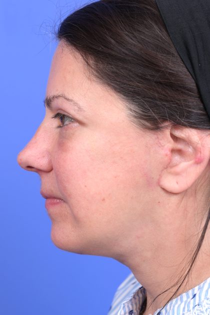 Upper Blepharoplasty Before & After Patient #10644