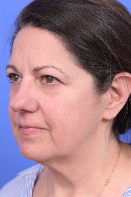 Upper Blepharoplasty Before & After Patient #10644