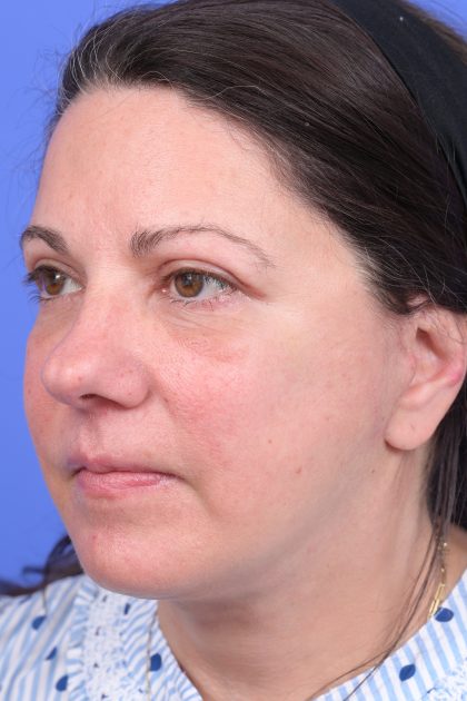 Upper Blepharoplasty Before & After Patient #10644