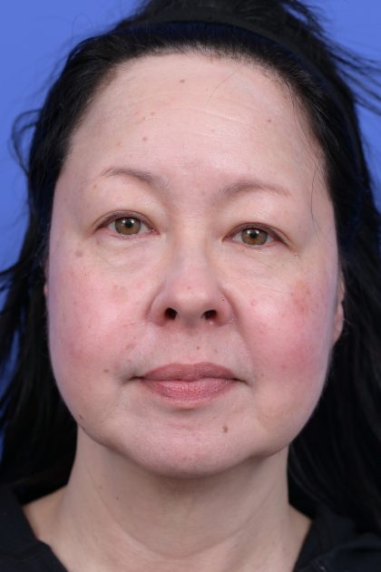 Upper Blepharoplasty Before & After Patient #10636