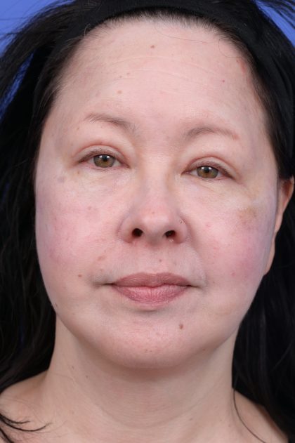 Upper Blepharoplasty Before & After Patient #10636