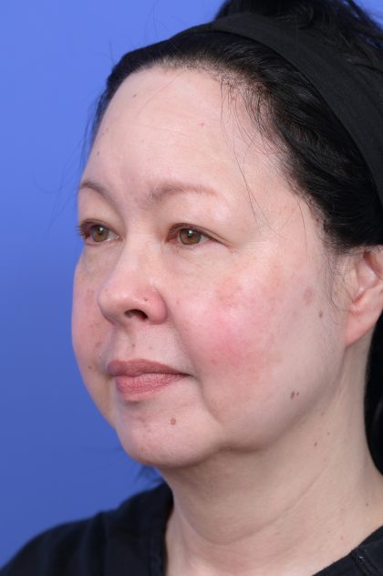 Upper Blepharoplasty Before & After Patient #10636