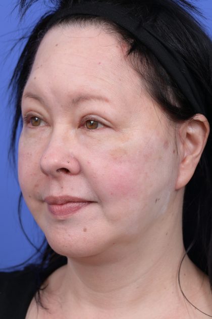 Upper Blepharoplasty Before & After Patient #10636